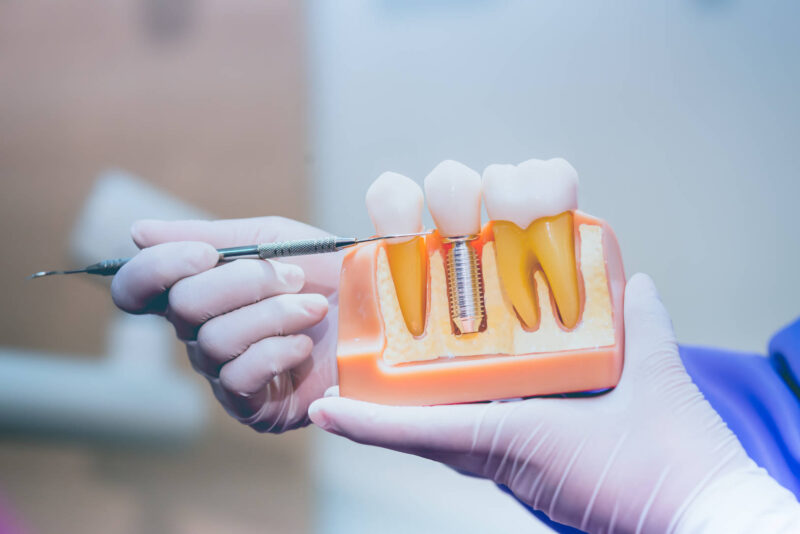 Coroană dentară pe implant